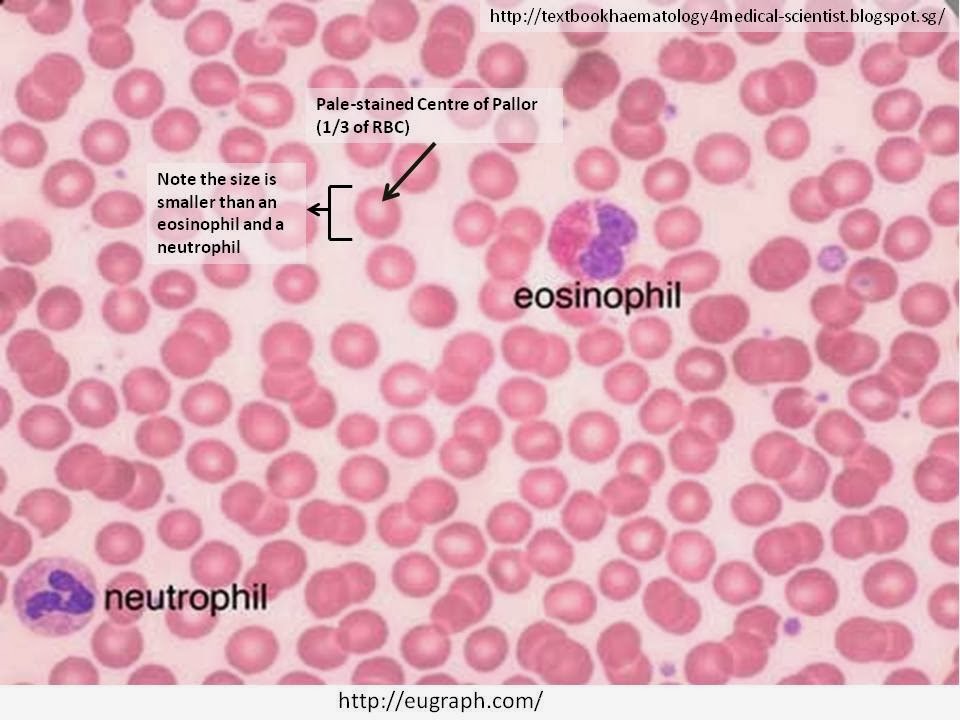 Haematology In A NutShell: Red Blood Cell Morphology - 960x720 - jpeg Abnormal Red Blood Cell Size